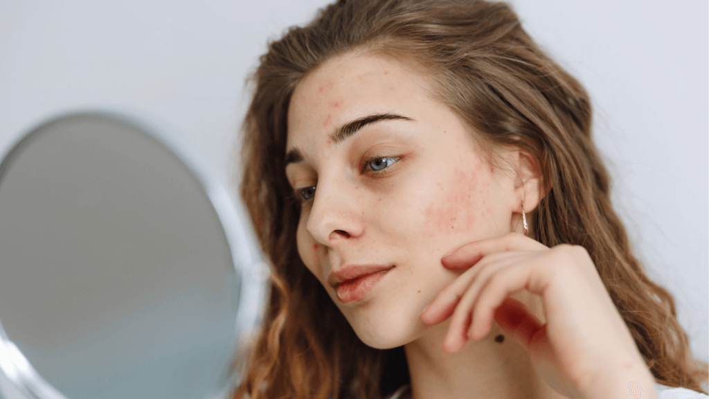 Tratamentos para os diferentes tipos de acne: como o laser atua na inflamação e nas cicatrizes
