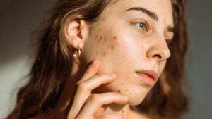 Cicatriz de acne: como tratar com menos agressão e mais segurança clínica