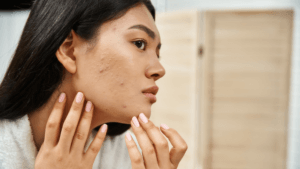 Laser para acne: como funciona e quais os resultados esperados