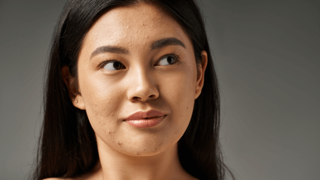 Causas e tratamento da acne da mulher adulta